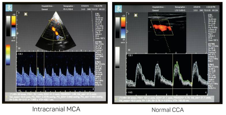 Допплеровская система Digi-Lite